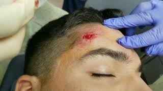 Forehead Lipoma Excision