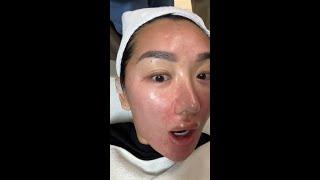 12 LASER SKIN TREATMENTS IN KOREA
