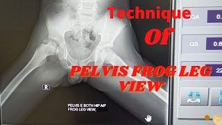 Technique of Pelvis frog view (Ep-38) |Pelvis with hip frog view |Frog leg position |Tutorial