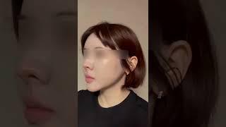리쥬란 3번보다 좋은 줄기세포피부주사 2주차
