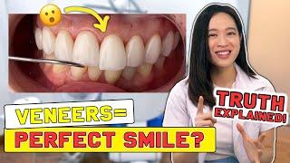 Veneers? Crowns? Smile Makeover MUST-KNOWS | #SmileMakeover !