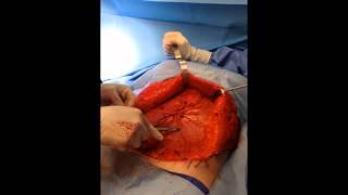 Muscle Diastasis Repair in a Tummy Tuck, Inside the Operating Room with Dr. Navin Singh