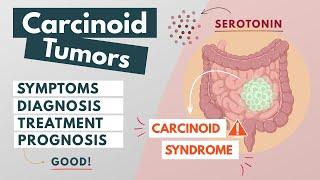 Carcinoid Tumor | Visual Explanation | Symptoms, diagnosis, treatment, prognosis