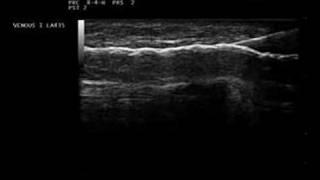 Sclerotherapy Biosound Esaote MyLab, Ultrasound Guided