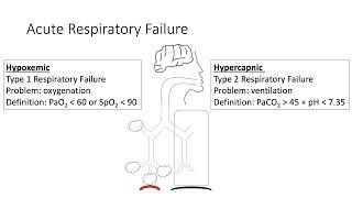 Acute Respiratory Failure