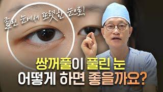 쌍꺼풀 안풀리게 수술하는 방법