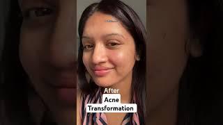 Acne transformation Credits : mamata_3793 via IG #acnejourney #acnetreament #acne