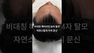 비대칭 헤어라인 M자 탈모 자연스럽게 커버