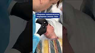 Убираем морщины возле глаз.