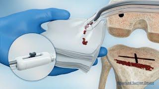 Intervoke Medical Device Animation #medicaldevice  #medicalmarketing