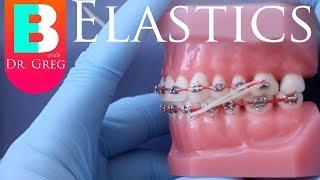 [BRACES EXPLAINED] Elastics / Rubber Bands