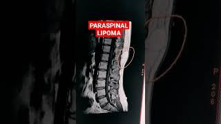 Paraspinal Lipoma #mri #shorts #mri_radiographer MRI Dorso Lumbar Spine - T1W Sequence.