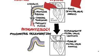 Mitral Valve Prolapse