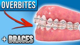 How Do BRACES FIX Overbites? | Overbite Before and After Braces | Premier Orthodontics