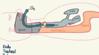 PALS 02: Airway