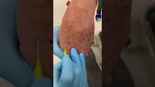 Another Difficult Cannula | #shorts #ivcannulation #anesthesiology #nurse