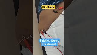 Dry Needle/Sciatica nerve Treatment/Dry Needle For radiating pain/Back Pain/Dr.Anup Patel