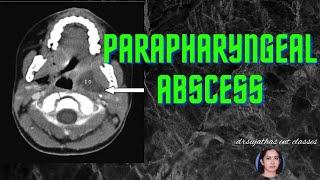 171.Parapharyngeal Abscess #surgeryeducation #shortnotes #medicalstudent #ent #clinicalexamination