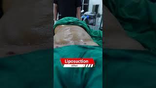 Liposuction surgery before and after results | Dezire Clinic #drprashantyadav #shorts #shortvideo