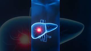 Stage 1 to Stage 4: What Liver Cirrhosis Really Looks Like