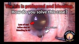 Cataract Quiz: Iris bleed & prolapse during surgery - now what?