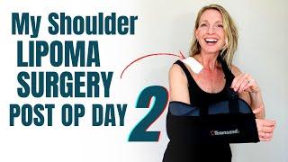 My Shoulder Lipoma Removal: 2 Days Post Op