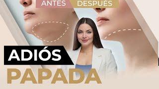 Elimina la papada en menos de una semana | 5 Tratamientos que FUNCIONAN