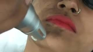 Skin Pigmentation Removal on Face at Delhi Laser Clinic