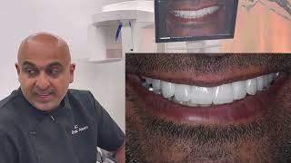 Smile Design with Feldspathic Veneers, Implants and Implant Crowns