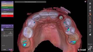 exocad AI assisted implant crown design