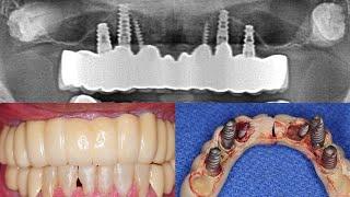 Treatment of a Patient with Full-Mouth Dental Implant Complications