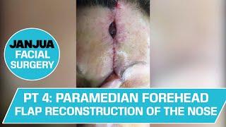 PART 4 - 1 WEEK POST OP - PARAMEDIAN FOREHEAD FLAP RECONSTRUCTION OF THE NOSE - DR. TANVEER JANJUA