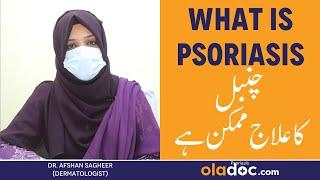 Psoriasis Kya Hai - Psoriasis Treatment In Urdu - Chambal Ki Bimari Ka Ilaj - Psoriasis Removal