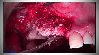 GBR & Implant Placement - Maxgraft, Collprotect & Mucoderm (Botiss) by Dr Bernard Dahan