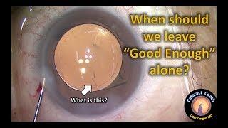 when should we leave "good enough" alone in cataract surgery?
