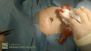 Open Umbilical Hernia Repair at California Hernia Specialists (4K)