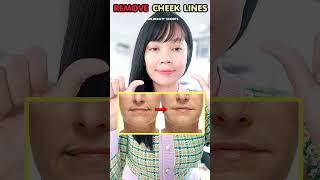 Remove Smile Lines and Cheek Lines Fast #cheeklines #smilelines #facemassage