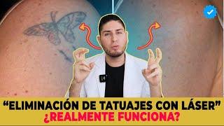 Tecnicas de eliminación de tatuaje ¿El láser es mejor? | DOCTOR LEMUS