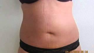 SmartLipo Liposuction Before and After Pictures-Los Angeles-Pasadena-Irvine