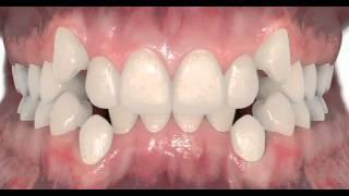 Non-Extraction permanent teeth - Dr. Matthew David McNutt, Orthodontist