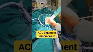 Live  Knee Ligament ACL View In Camera ️#acltear #aclinjury #aclrecovery #ligamentinjury #ligament