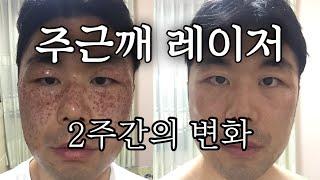 기미 주근깨 레이저 2주간의 변화