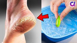 7 Cracked Heels Home Remedy! Dry Skin Care |  @Artkala