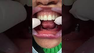 Acrylic dental prosthesis vs. on implants #viral #dentist #mrdent #smile #smiledentist