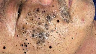 Big Cystic Acne Blackheads Extraction Blackheads & Milia, Whiteheads Removal Pimple Popping # 65484