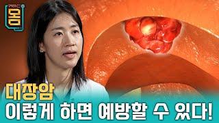 [Full] 대장암, 이렇게 하면 예방할 수 있다!ㅣ귀하신 몸ㅣ43화 대장암의 씨앗, 대장 용종 예방법