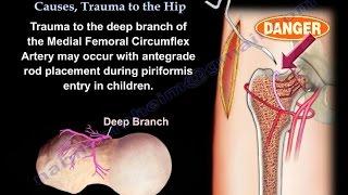 AVN Femoral Head  Causes, Trauma To The Hip - Everything You Need To Know - Dr. Nabil Ebraheim