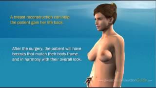 Breast Reconstruction Guide