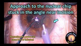 How to safely remove a nuclear piece near the incision in Cataract Surgery