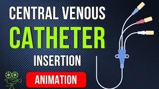  CENTRAL VENOUS CATHETER (CVC) INSERTION PROCEDURE | ANIMATED EXPLANATION